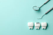 虫歯を治療した歯はまた虫歯になるの？？何度も虫歯になってしまうのはなぜ？？