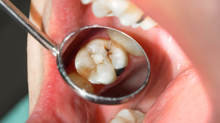 虫歯の治療が１回で終わらないのはなぜ？？