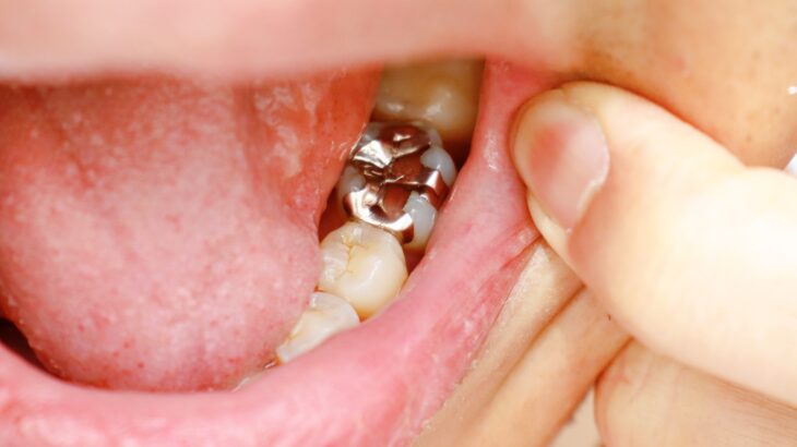 銀歯の影響について