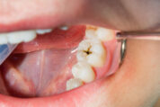 虫歯の進行状態で治療は違うの？？